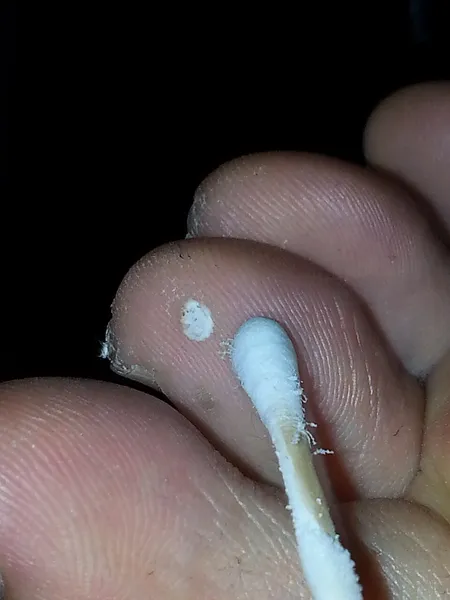 Cryosurgery