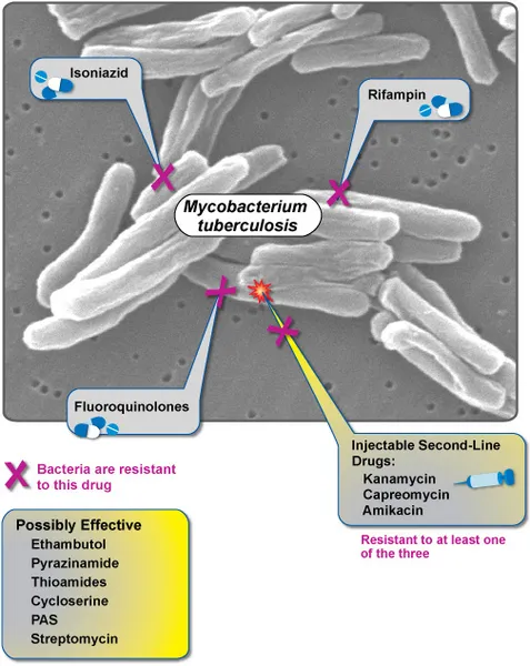 Extensively drug-resistant tuberculosis