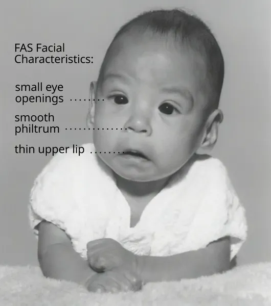Fetal alcohol spectrum disorder