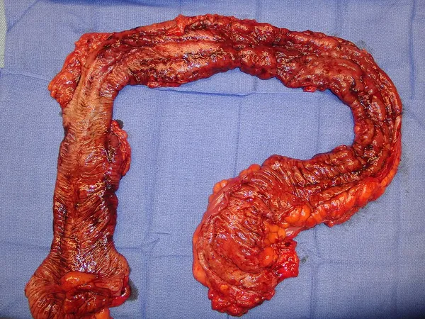Colectomy