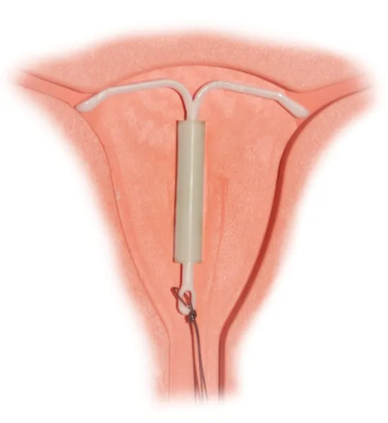 Hormonal intrauterine device