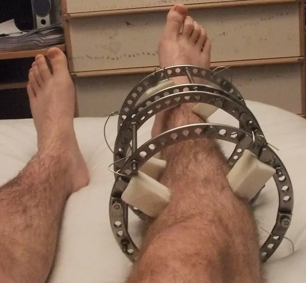 Ilizarov apparatus
