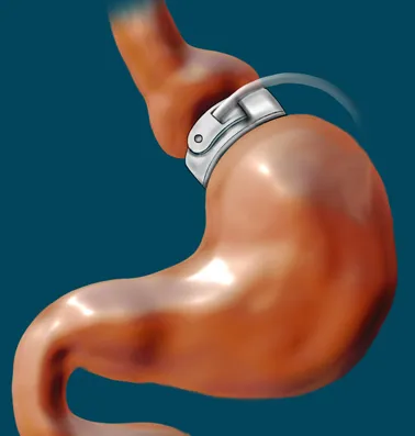 Adjustable gastric band