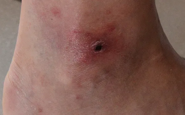 African tick bite fever