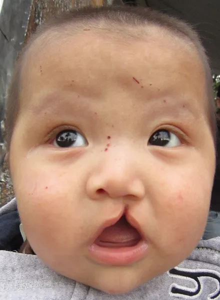 Cleft lip and cleft palate