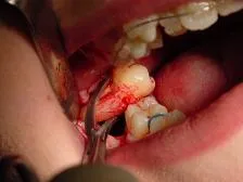 Dental extraction