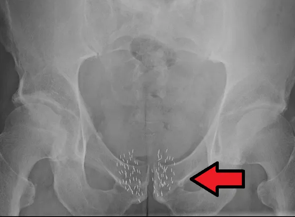 Brachytherapy