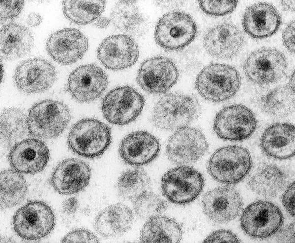 HIV/AIDS denialism