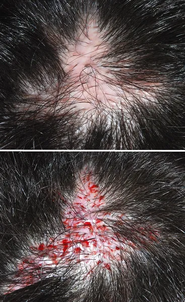 Hair transplantation
