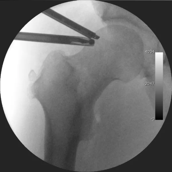Hip arthroscopy