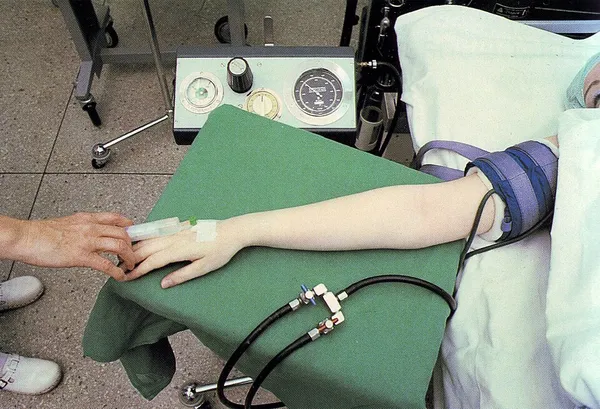 Intravenous regional anesthesia