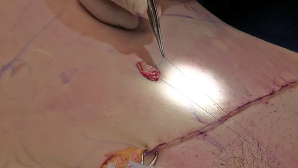 Abdominoplasty