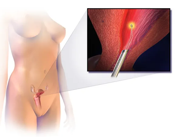 Endometrial ablation