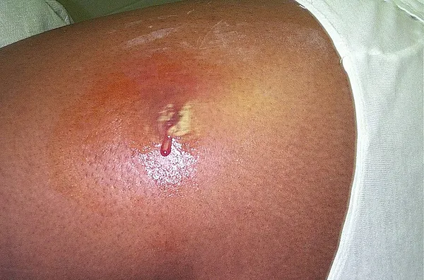 Infection