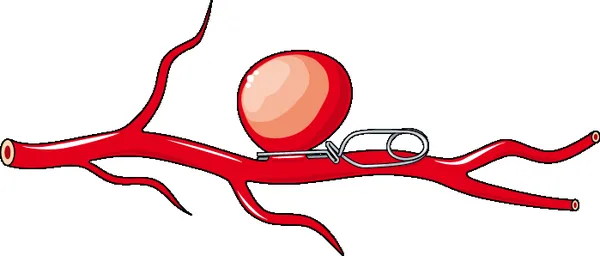 Clipping (medicine)