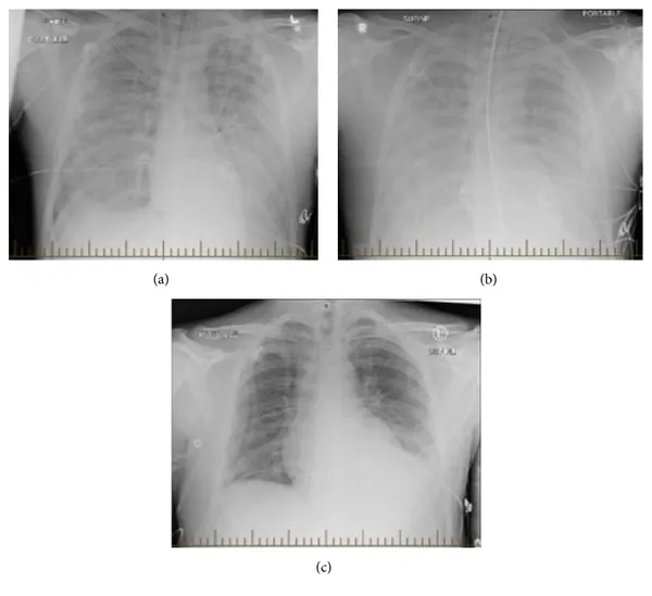Hantavirus pulmonary syndrome
