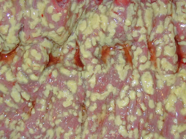 Clostridioides difficile infection