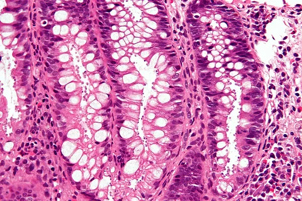 1993 Milwaukee cryptosporidiosis outbreak