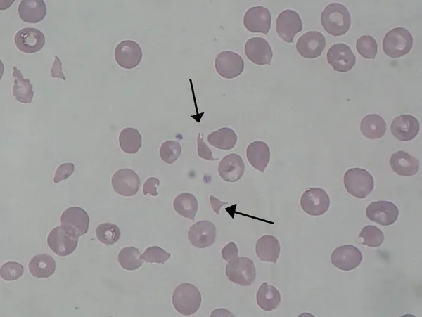 Hemolytic–uremic syndrome