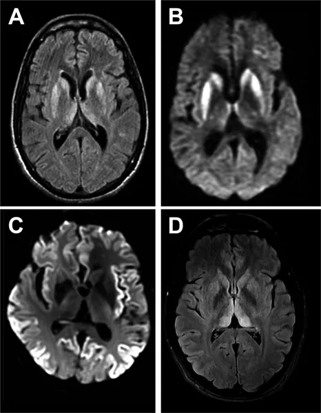 Creutzfeldt–Jakob disease