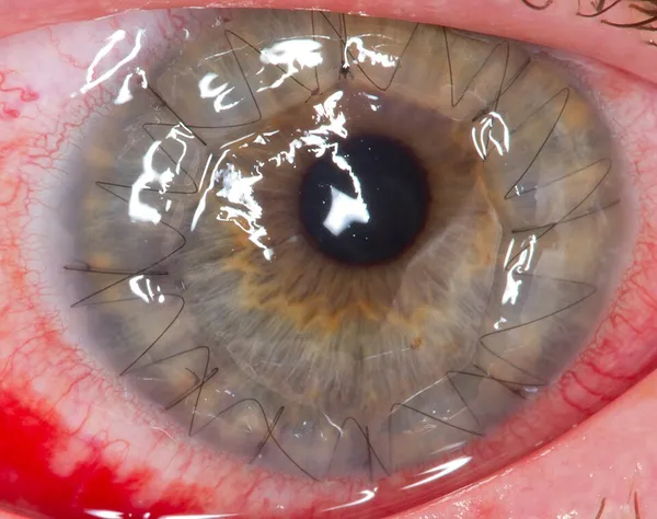 Corneal button
