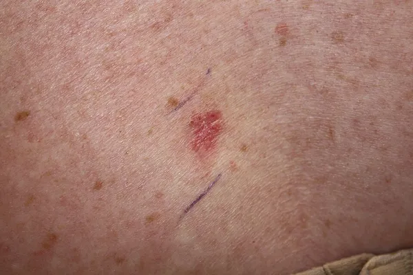 Basal-cell carcinoma