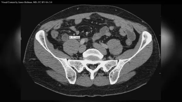 Appendicitis