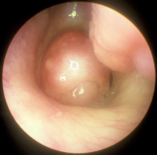 Functional endoscopic sinus surgery