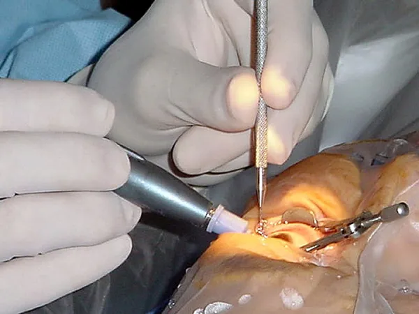 History of cataract surgery