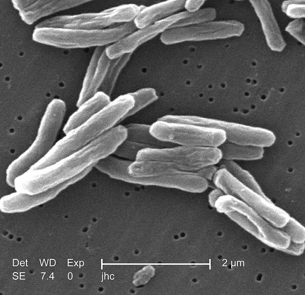 2024–2025 Kansas tuberculosis outbreak