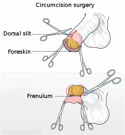 Circumcision