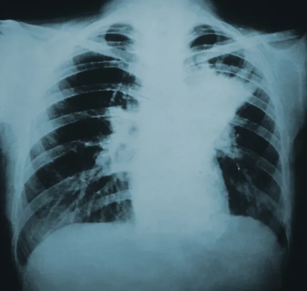Blastomycosis