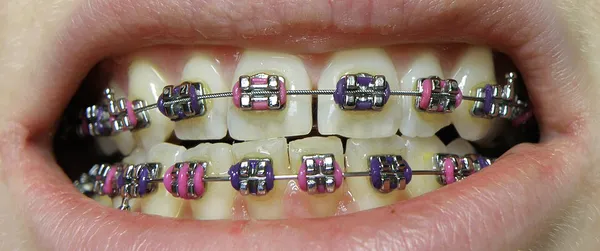 Dental braces