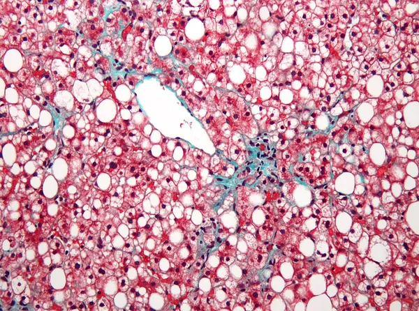 Fatty liver disease